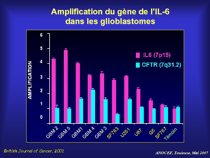 Amplification du gène de l’IL-6 dans les glioblastomes British Journal of Cancer, 2001 ANOCEF,