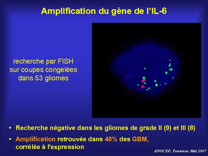 Amplification du gène de l’IL-6 recherche par FISH sur coupes congelées dans 53 gliomes