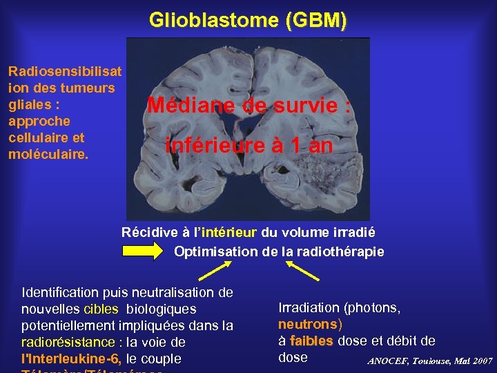 Glioblastome (GBM) Radiosensibilisat ion des tumeurs gliales : approche cellulaire et moléculaire. Médiane de