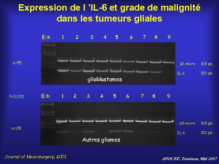 Expression de l ’IL-6 et grade de malignité dans les tumeurs gliales Ech 1