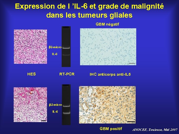 Expression de l ’IL-6 et grade de malignité dans les tumeurs gliales GBM négatif