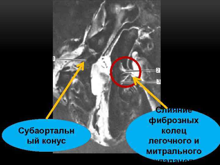 Субаортальн ый конус Слияние фиброзных колец легочного и митрального клапанов 