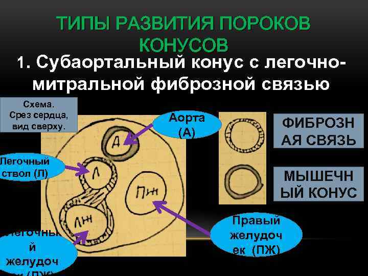 ТИПЫ РАЗВИТИЯ ПОРОКОВ КОНУСОВ 1. Субаортальный конус с легочномитральной фиброзной связью Схема. Срез сердца,