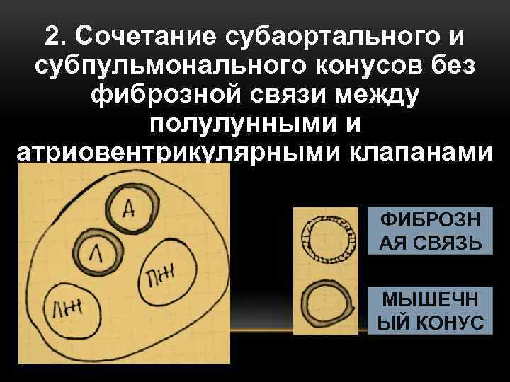 2. Сочетание субаортального и субпульмонального конусов без фиброзной связи между полулунными и атриовентрикулярными клапанами