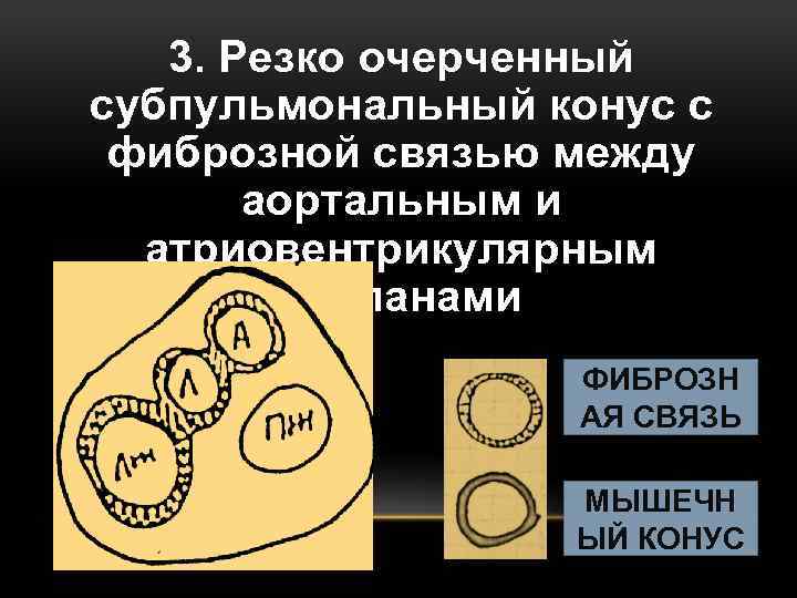 3. Резко очерченный субпульмональный конус с фиброзной связью между аортальным и атриовентрикулярным клапанами ФИБРОЗН