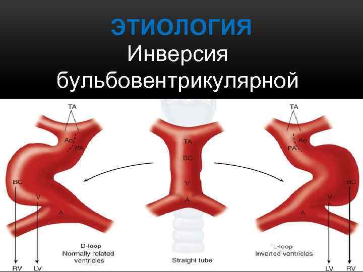 ЭТИОЛОГИЯ Инверсия бульбовентрикулярной петли 