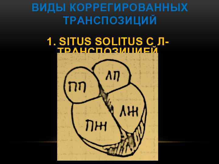 ВИДЫ КОРРЕГИРОВАННЫХ ТРАНСПОЗИЦИЙ 1. SITUS SOLITUS С ЛТРАНСПОЗИЦИЕЙ 