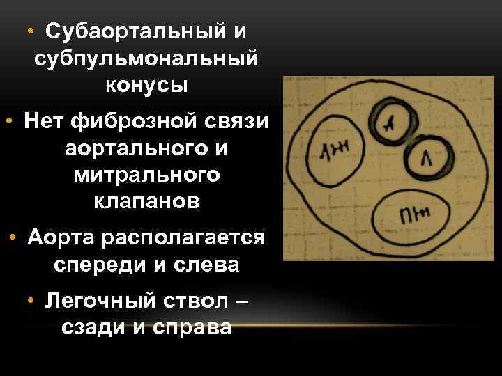  • Субаортальный и субпульмональный конусы • Нет фиброзной связи аортального и митрального клапанов