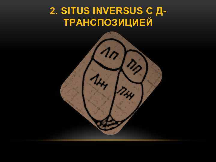 2. SITUS INVERSUS С ДТРАНСПОЗИЦИЕЙ 