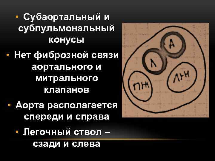  • Субаортальный и субпульмональный конусы • Нет фиброзной связи аортального и митрального клапанов