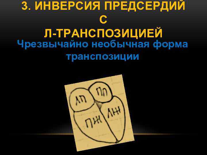 3. ИНВЕРСИЯ ПРЕДСЕРДИЙ С Л-ТРАНСПОЗИЦИЕЙ Чрезвычайно необычная форма транспозиции 