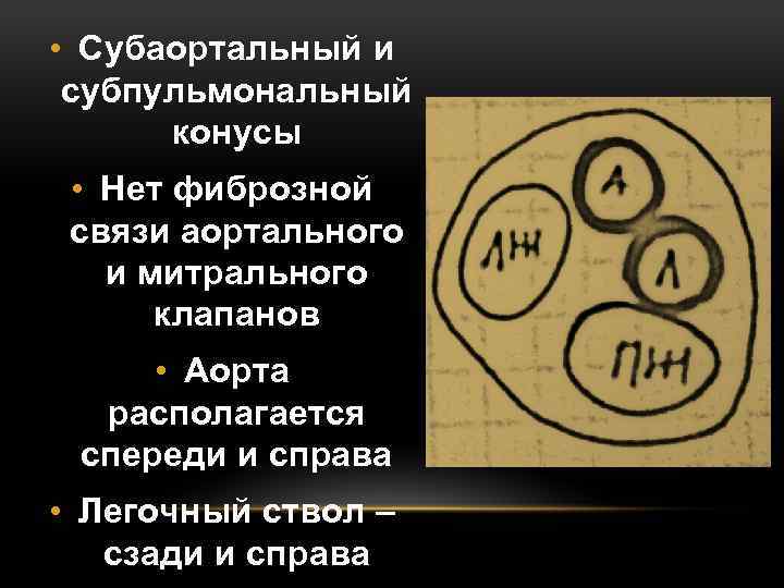  • Субаортальный и субпульмональный конусы • Нет фиброзной связи аортального и митрального клапанов