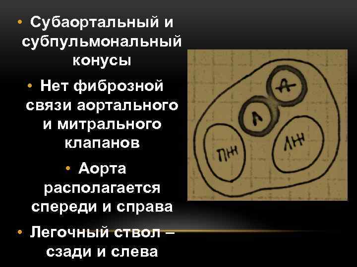  • Субаортальный и субпульмональный конусы • Нет фиброзной связи аортального и митрального клапанов