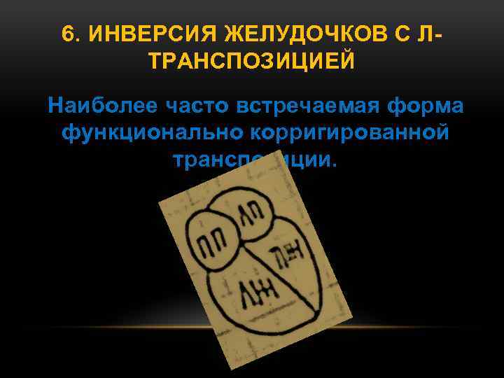 6. ИНВЕРСИЯ ЖЕЛУДОЧКОВ С ЛТРАНСПОЗИЦИЕЙ Наиболее часто встречаемая форма функционально корригированной транспозиции. 