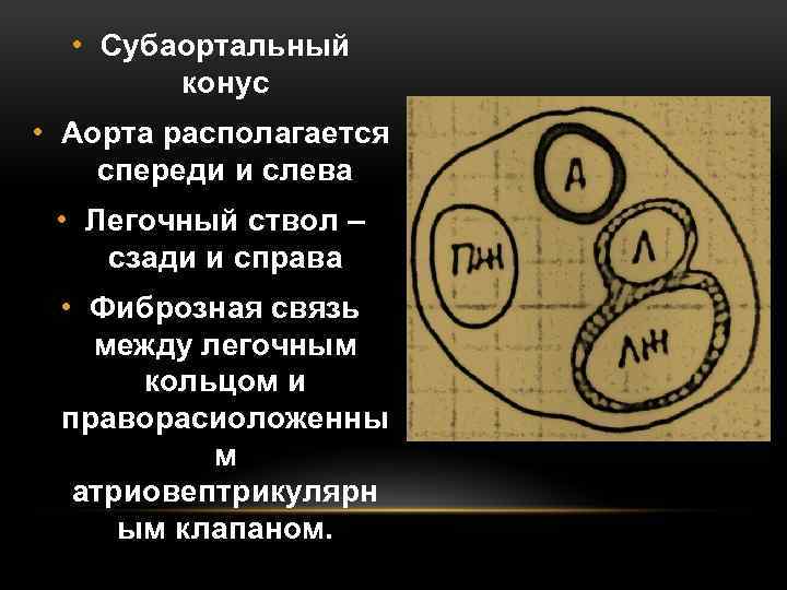  • Субаортальный конус • Аорта располагается спереди и слева • Легочный ствол –