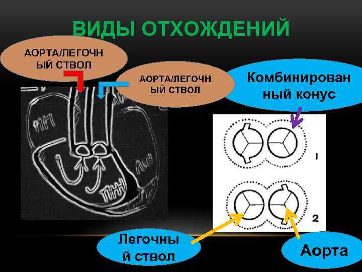 ВИДЫ ОТХОЖДЕНИЙ АОРТА/ЛЕГОЧН ЫЙ СТВОЛ Легочны й ствол Комбинирован ный конус Аорта 