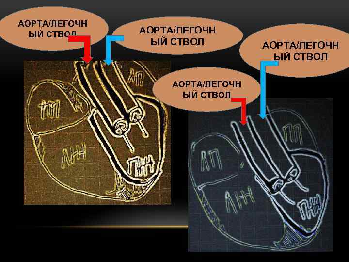 АОРТА/ЛЕГОЧН ЫЙ СТВОЛ 