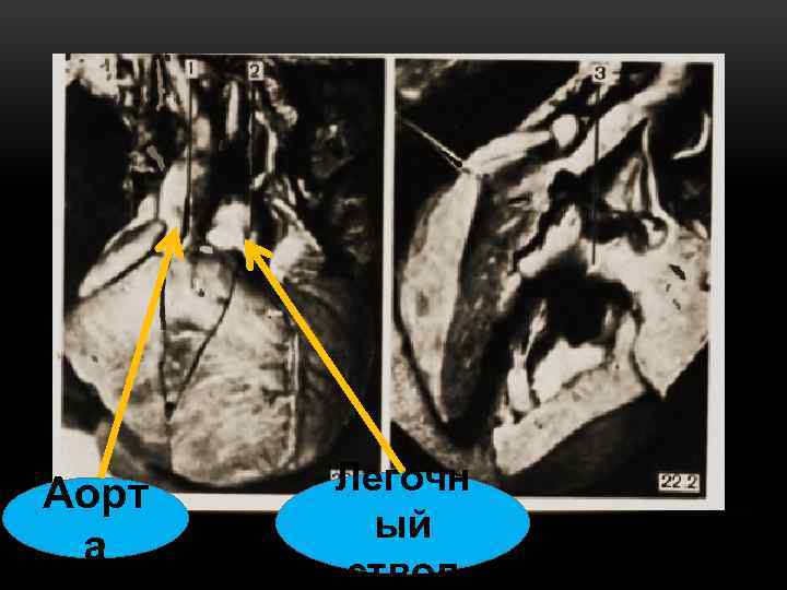 Аорт а Легочн ый ствол 