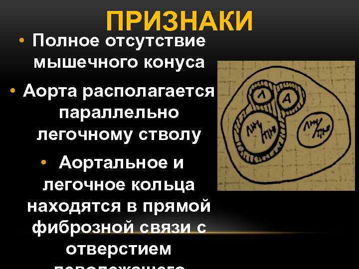 ПРИЗНАКИ • Полное отсутствие мышечного конуса • Аорта располагается параллельно легочному стволу • Аортальное