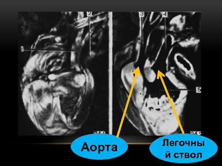 Аорта Легочны й ствол 