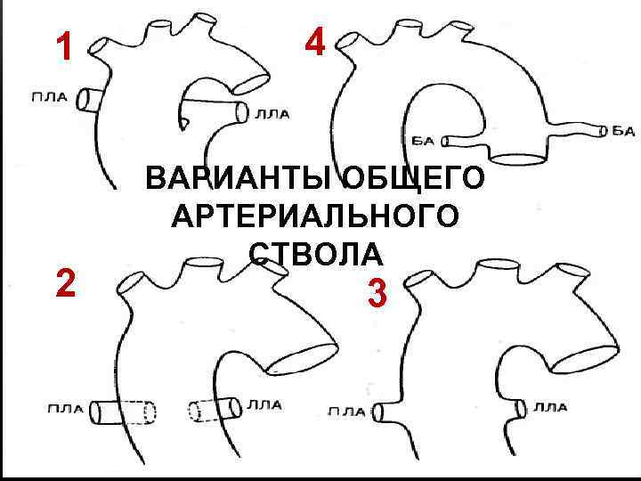 1 2 4 ВАРИАНТЫ ОБЩЕГО АРТЕРИАЛЬНОГО СТВОЛА 3 