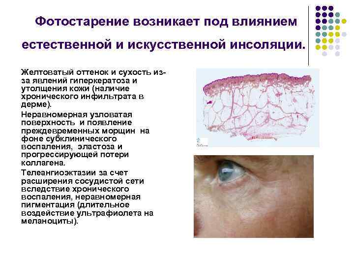 Фотостарение возникает под влиянием естественной и искусственной инсоляции. Желтоватый оттенок и сухость изза явлений