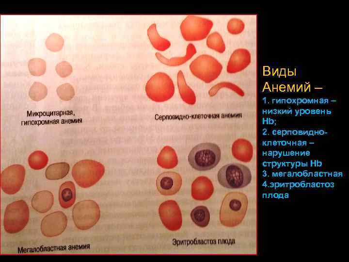 Серповидноклеточная анемия картина крови