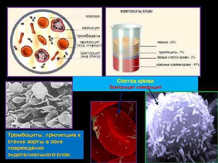 Состав крови Эритроцит лимфоцит Тромбоциты, прилипшие к стенке аорты в зоне повреждения эндотелиального слоя.