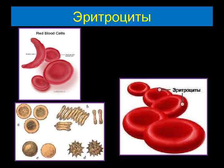 Эритромиелоз картина крови