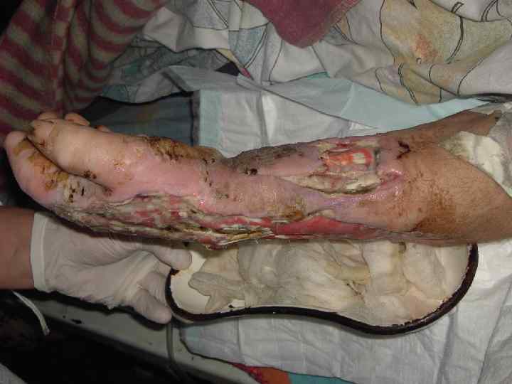 СТАДИИ БОЛЕЗНИ СПИДА 1. Заражение вирусом ВИЧ: недельная лихорадка, увеличение лимфоузлов, сыпь. Через месяц