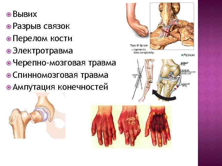  Вывих Разрыв связок Перелом кости Электротравма Черепно-мозговая травма Спинномозговая травма Ампутация конечностей 