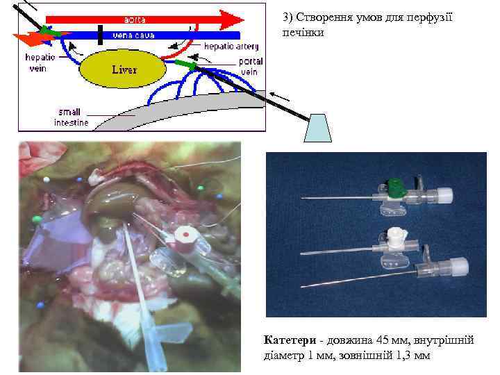 3) Створення умов для перфузії печінки Катетери - довжина 45 мм, внутрішній діаметр 1