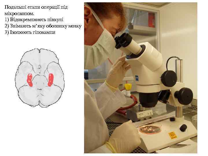 Подальші етапи операції під мікроскопом. 1) Відокремлюють півкулі 2) Знімають м‘яку оболонку мозку 3)