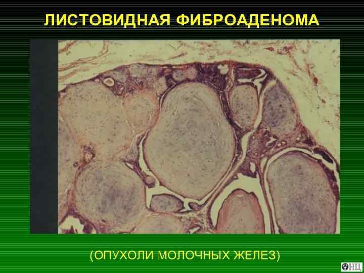 Фиброаденома молочной. Филлоидная (листовидная) опухоль. Филлоидная опухоль молочной железы гистология. Листовидная опухоль молочной железы микропрепарат. Листовидная фиброаденома молочной железы микропрепарат.