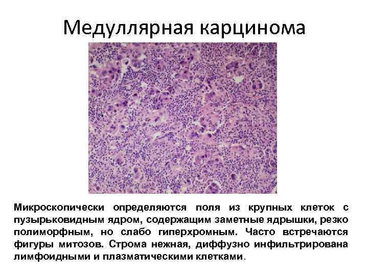 Медуллярная карцинома Микроскопически определяются поля из крупных клеток с пузырьковидным ядром, содержащим заметные ядрышки,