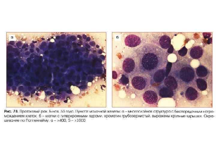 Клетки молочных желез. Клетки молочной железы цитология. Цитология при онкологии молочной железы. Клетка карциномы молочной железы. Цитология злокачественных клеток мочевого пузыря.