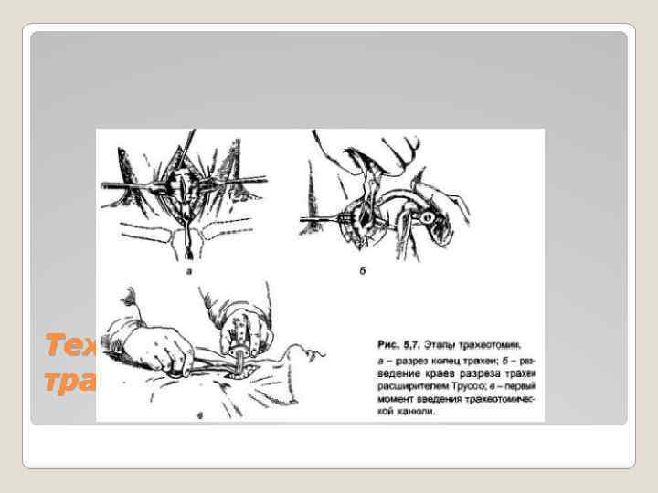Техника операции (верхняя трахеотомия) 