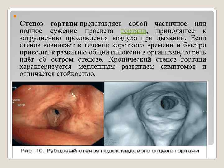  Стеноз гортани представляет собой частичное или полное сужение просвета гортани, приводящее к затруднению