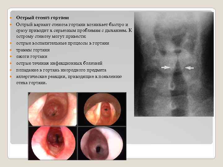  Острый стеноз гортани Острый вариант стеноза гортани возникает быстро и сразу приводит к