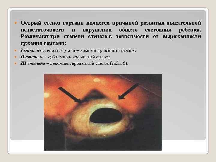  Острый стеноз гортани является причиной развития дыхательной недостаточности и нарушения общего состояния ребенка.
