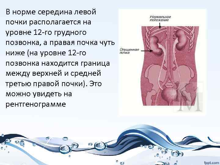 Нефроптоз почек мкб