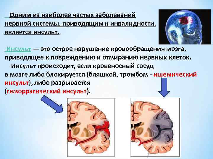 Одним из наиболее частых заболеваний нервной системы, приводящим к инвалидности, является инсульт. Инсульт —