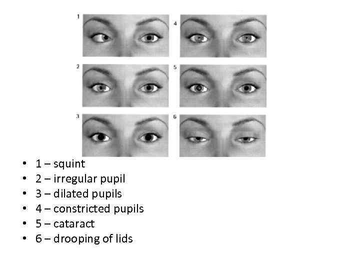  • • • 1 – squint 2 – irregular pupil 3 – dilated