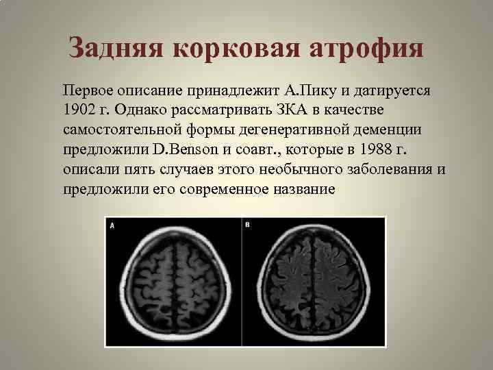Задняя корковая атрофия Первое описание принадлежит А. Пику и датируется 1902 г. Однако рассматривать