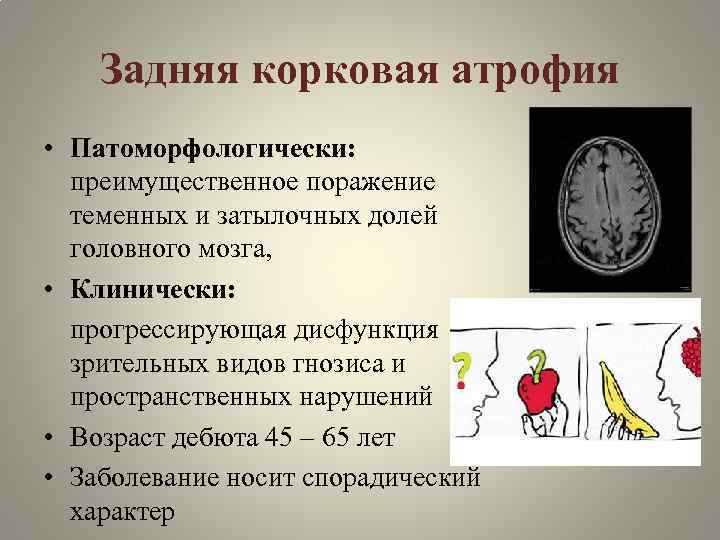Задняя корковая атрофия • Патоморфологически: преимущественное поражение теменных и затылочных долей головного мозга, •
