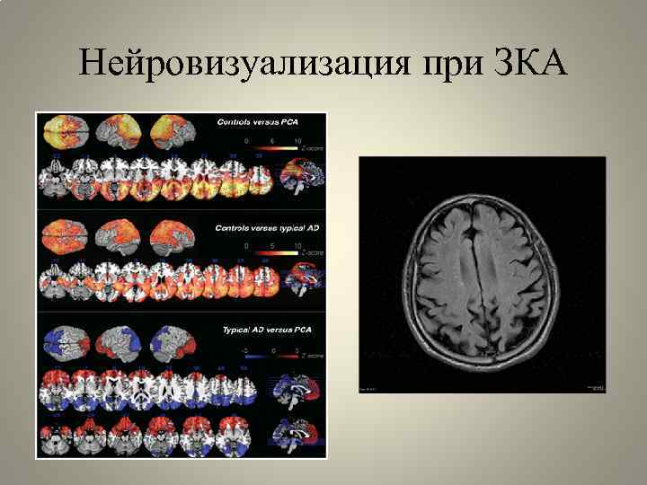 Нейровизуализация при ЗКА 