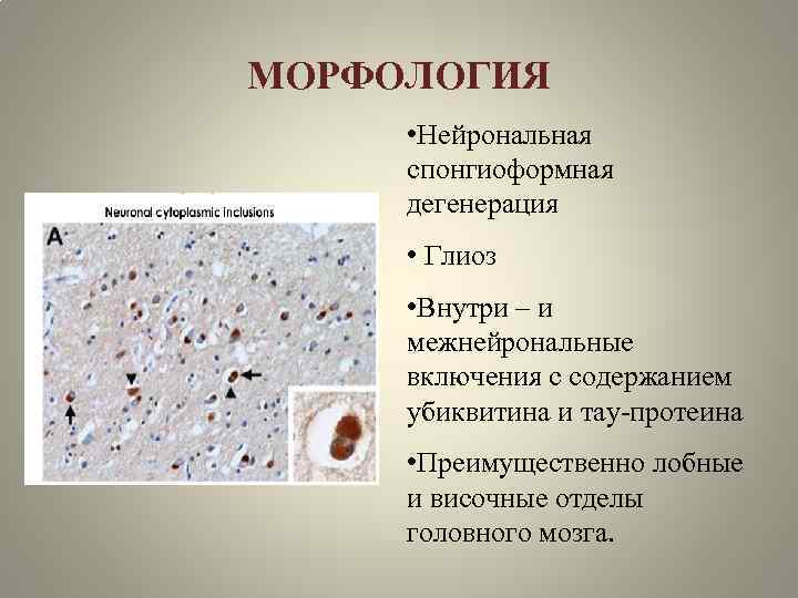 МОРФОЛОГИЯ • Нейрональная спонгиоформная дегенерация • Глиоз • Внутри – и межнейрональные включения с