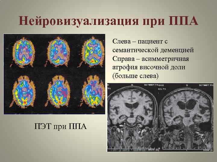 Нейровизуализация при ППА Слева – пациент с семантической деменцией Справа – асимметричная атрофия височной