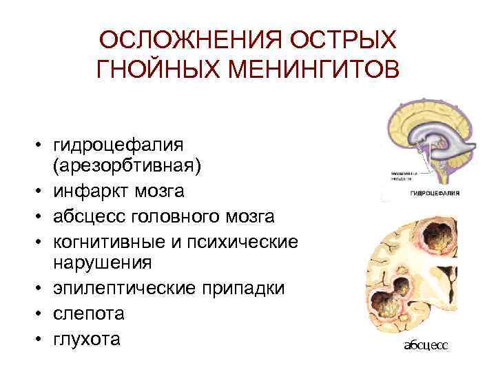 ОСЛОЖНЕНИЯ ОСТРЫХ ГНОЙНЫХ МЕНИНГИТОВ • гидроцефалия (арезорбтивная) • инфаркт мозга • абсцесс головного мозга