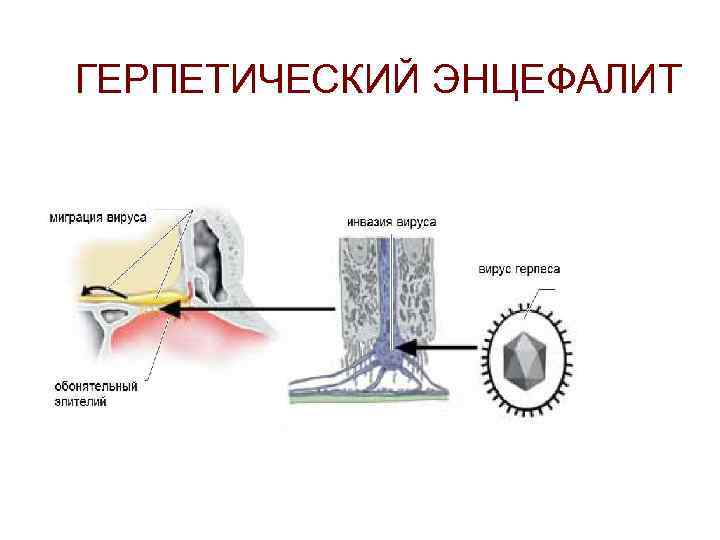 ГЕРПЕТИЧЕСКИЙ ЭНЦЕФАЛИТ 